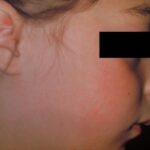 Child in profile with a malar facial rash due to rubella.