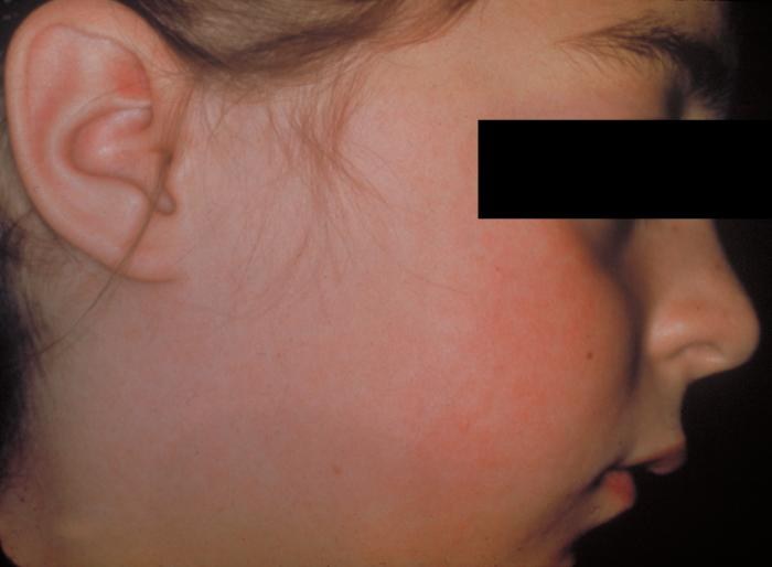 Child in profile with a malar facial rash due to rubella.