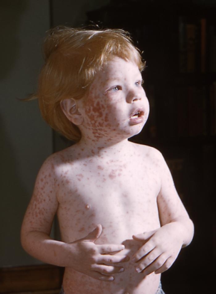 Characteristic maculopapular rash indicative of rubella on the upper chest of a young child.