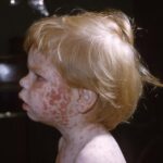 Characteristic maculopapular rash indicative of rubella on the face and upper chest of a young child.