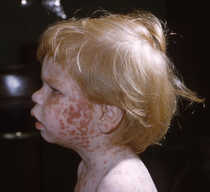 Characteristic maculopapular rash indicative of rubella on the face and upper chest of a young child.