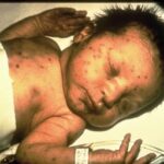 Infant with congenital rubella syndrome, laying down in a bed with white sheets.