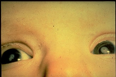 Cataracts caused by congenital rubella syndrome in a young child.