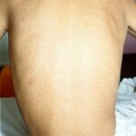 Rubella rash on back of seated young adult patient.