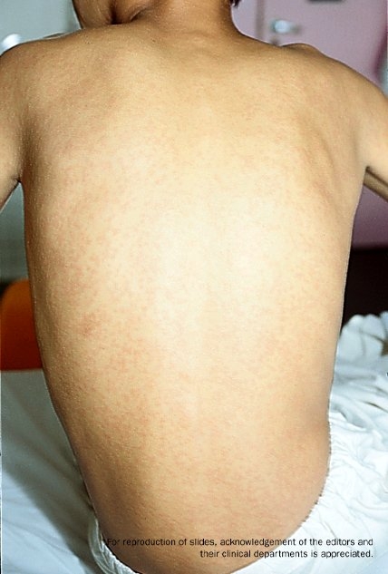 Rubella rash on back of seated young adult patient.