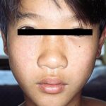 Rubella rash on young boy's face.