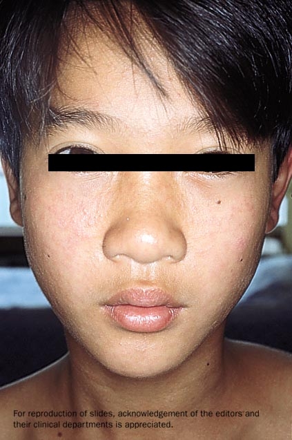 Rubella rash on young boy's face.