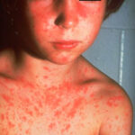 Rubella rash on the face, neck and chest of a young boy.