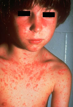 Rubella rash on the face, neck and chest of a young boy.