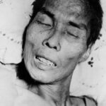 A 46-year-old man in Manila displaying characteristic facial muscle spasm known as rictus, caused by tetanus.