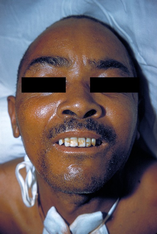 An adult patient with facial tetany, or contraction of the jaw and neck muscles.