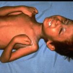 Child having painful muscle contractions from tetanus.