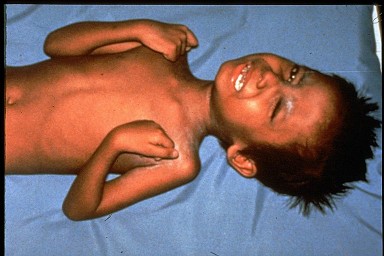 Child having painful muscle contractions from tetanus.