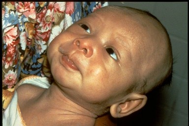 Baby with neonatal tetanus with neck and belly stiffness, and lockjaw.