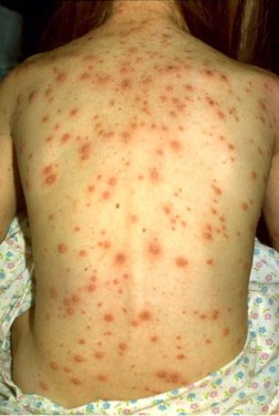 An adolescent female's back showing varicella lesions in various stages.