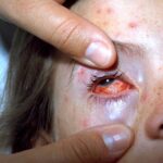 a young girl having her eye examined due to varicella with scleral lesions and bulbar conjunctivitis.