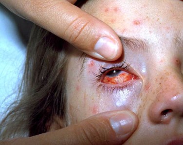 a young girl having her eye examined due to varicella with scleral lesions and bulbar conjunctivitis.
