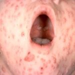 The open mouth of a child with chickenpox lesions on their palate.