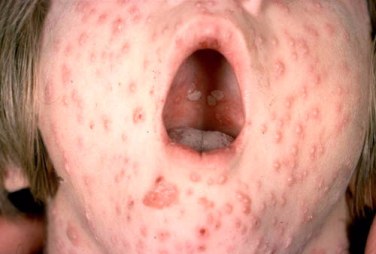 The open mouth of a child with chickenpox lesions on their palate.