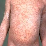 The torso of a child with chickenpox lesions scattered across his torso, neck, arms, and upper legs.