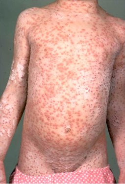 The torso of a child with chickenpox lesions scattered across his torso, neck, arms, and upper legs.