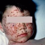 A young boy with chickenpox (varicella) with recent group A streptococcal pharyngitis.