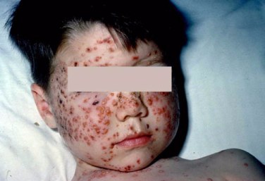 A young boy with chickenpox (varicella) with recent group A streptococcal pharyngitis.