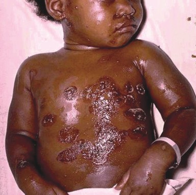 A child's chest showing superinfected varicella lesions.