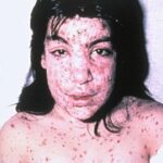 A 9-year-old girl's head and shoulders showing developed Staphylococcus aureus infection of her varicella lesions.