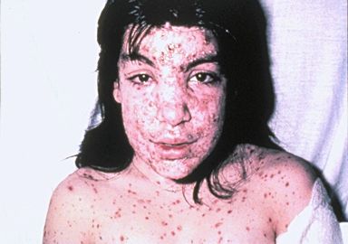 A 9-year-old girl's head and shoulders showing developed Staphylococcus aureus infection of her varicella lesions.