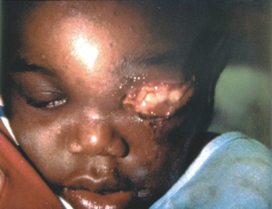 An infant's face with bandaging over one eye, showing necrotizing fasciitis, a complication of chickenpox (varicella).