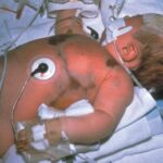 An infant with tubes and patches coming to and from his body.