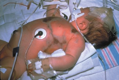 An infant with tubes and patches coming to and from his body.
