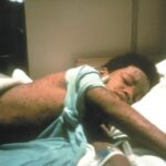A 10-year-old boy in bed, showing his chickenpox across his torso.