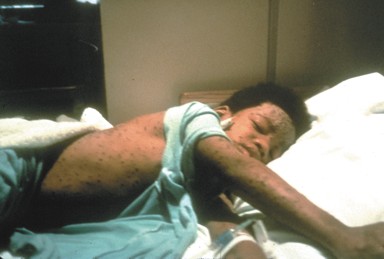 A 10-year-old boy in bed, showing his chickenpox across his torso.