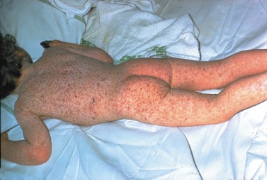 The back side of a young child with chickenpox all over the back, legs, and buttocks.