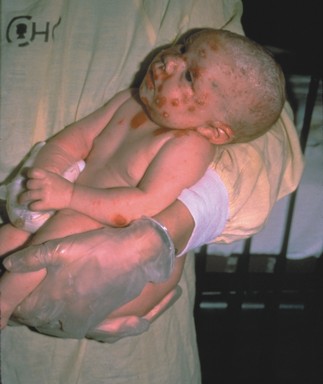 An infant in a doctor's arms showing facial chickenpox lesions.