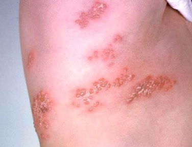 Herpes zoster on the torso of an otherwise healthy child.