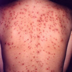 A 30-year-old female with acute chickenpox infection on her back.