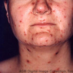 A 30-year-old female with acute chickenpox infection on her face and neck.