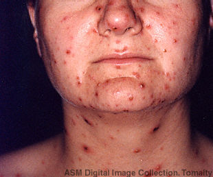A 30-year-old female with acute chickenpox infection on her face and neck.