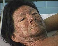 An alternate view of a Brazilian Arawete Indian man's face covered in chickenpox.