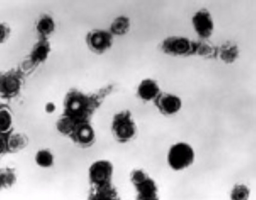Transmission electron micrograph of varicella-zoster virions from vesicle fluid of patient with chickenpox.