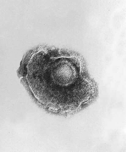 Electron micrograph of the chickenpox (varicella) virus.