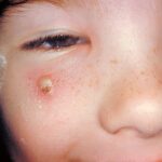 Close-up of a girl's face showing secondary skin infection due to chickenpox on her right cheek.