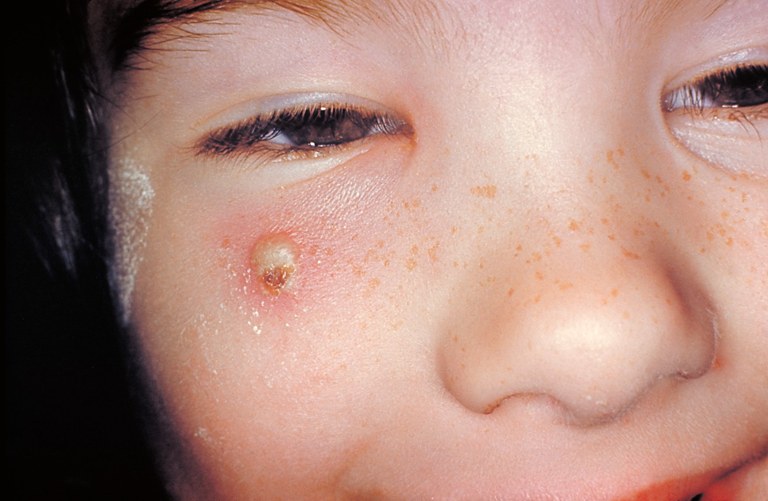 Close-up of a girl's face showing secondary skin infection due to chickenpox on her right cheek.