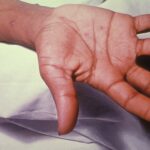 A child's hand showing chickenpox lesions on their palm and wrist.