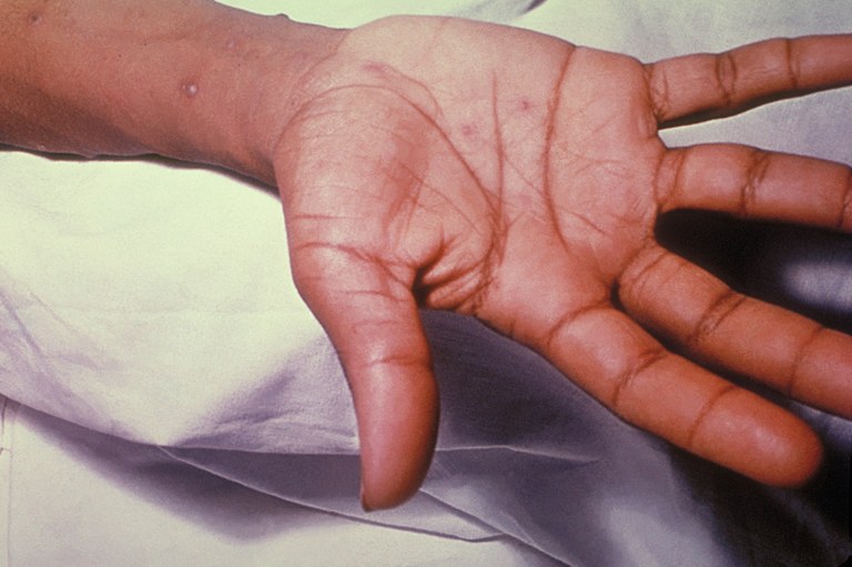 A child's hand showing chickenpox lesions on their palm and wrist.