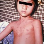 Chickenpox lesions on the chest of a young boy on day 5 of the illness.