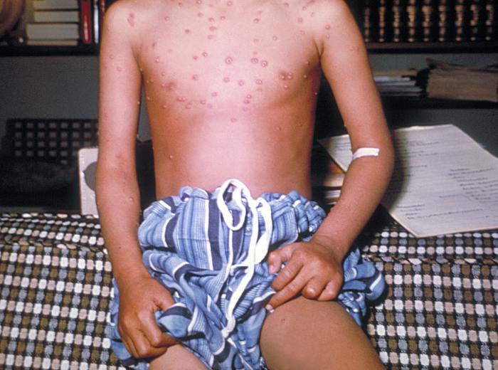 Chickenpox lesions on the torso of four-year-old child sitting on the edge of a bed on day 5 of his illness.